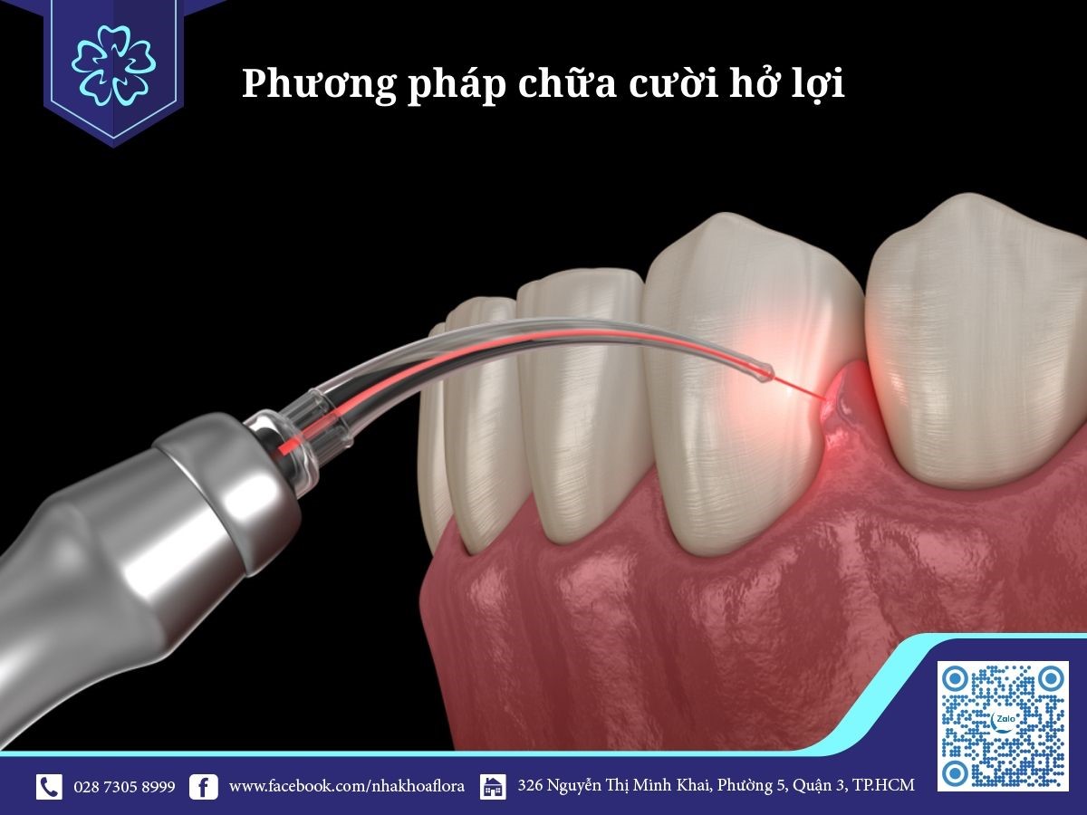 Chứa cười hở lợi hương pháp cắt nướu thẩm mỹ bằng công nghệ Laser Chứa cười hở lợi hương pháp cắt nướu thẩm mỹ bằng công nghệ Laser