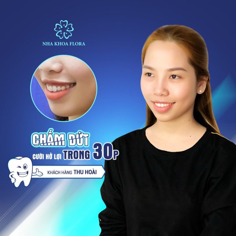 Chữa cười hở lợi ở đâu tốt nhất khách hàng Thu Hoài - Điều trị cười hở lợi