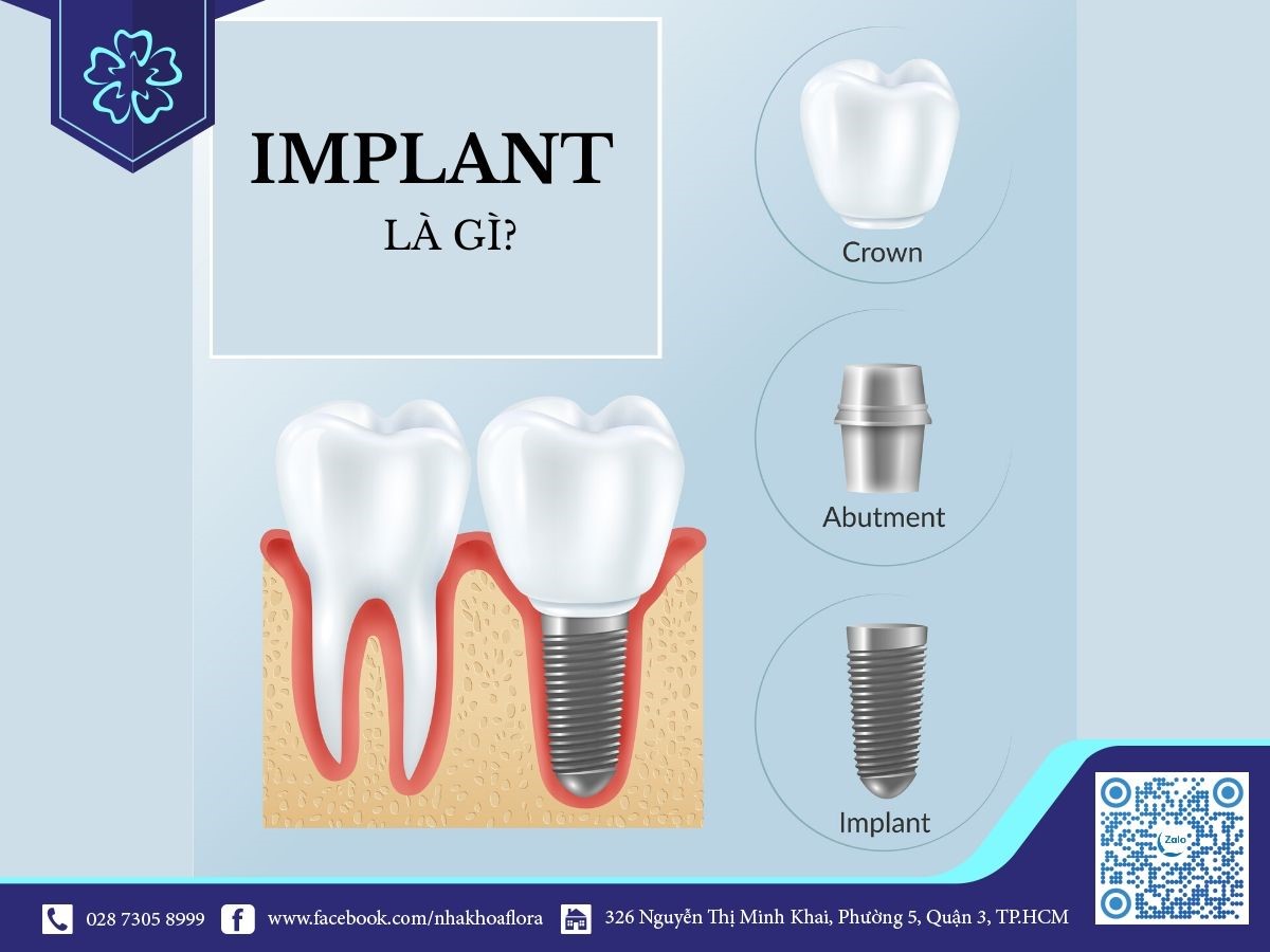 răng Implant cấu trúc cấy ghép răng Implant là gì