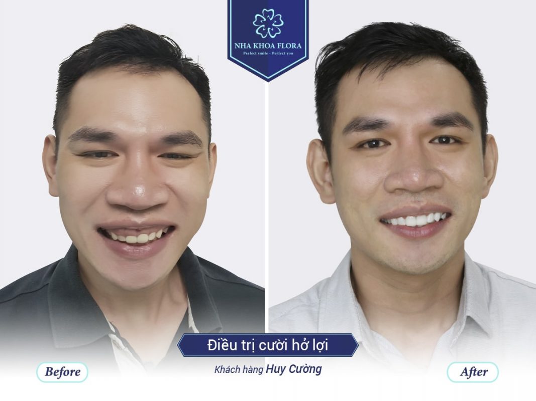Khách hàng điều trị cười hở lợi - Huy Cường Khách hàng điều trị cười hở lợi - Huy Cường