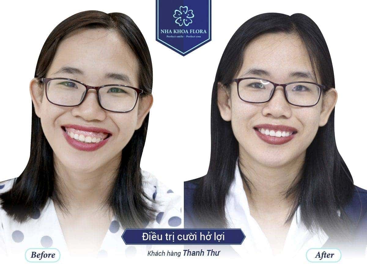 Customers with open smile treatment - Thanh Thu