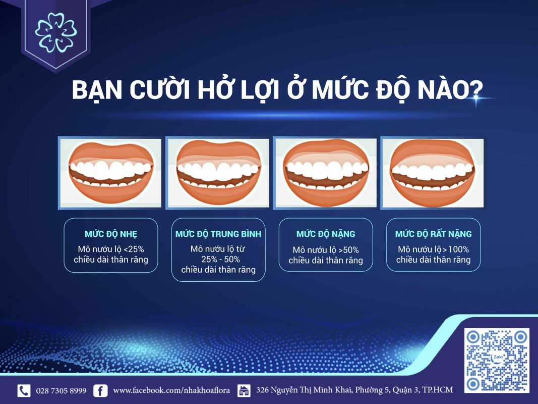 Các mức độ cười hở lợi Các mức độ cười hở lợi