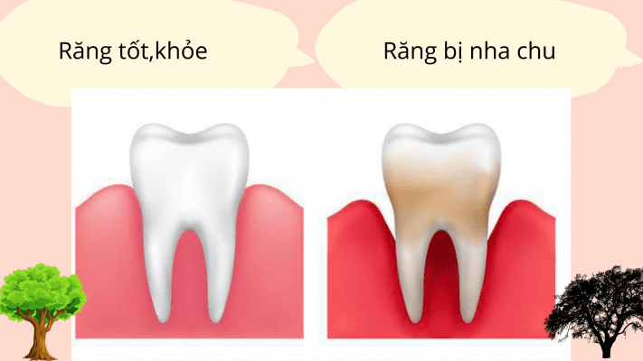 chua-viem-nha-tai-nha chữa viêm nha chu tại nhà
