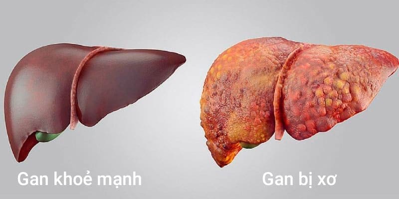 Bị hôi miệng do xơ gang Bị hôi miệng do xơ gang