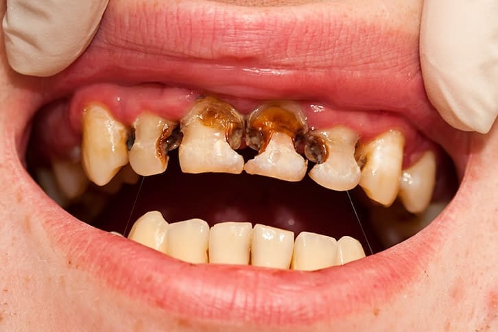Răng sâu không được nhổ có thể gây ra những cơn đau nhức nặng như thế nào?
