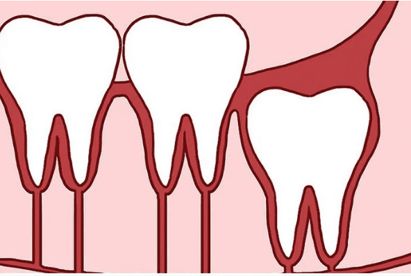 Răng khôn mọc thẳng đứng Răng khôn mọc thẳng đứng