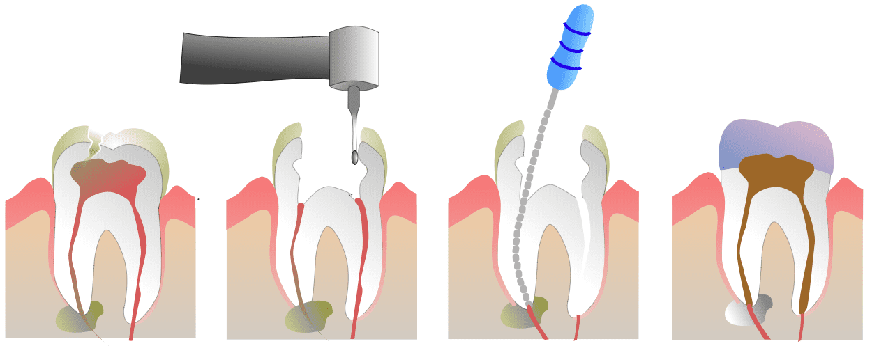 răng hàm bị sâu