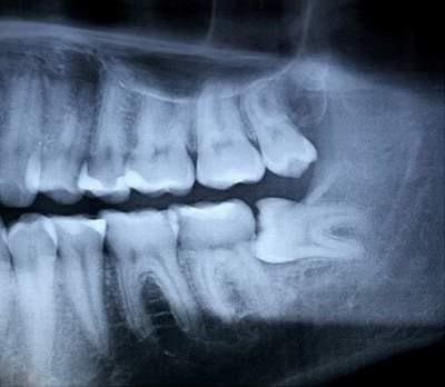 Răng khôn mọc đâm vào răng số 7 - Nên nhổ sớm Răng khôn mọc đâm vào răng số 7 - Nên nhổ sớm