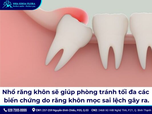 nhổ răng khôn đau mấy ngày - ảnh 1 nhổ răng khôn đau mấy ngày - ảnh 1