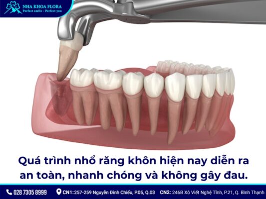 nhổ răng khôn đau mấy ngày - ảnh 2 nhổ răng khôn đau mấy ngày - ảnh 2