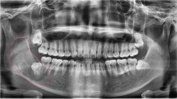 Răng khôn hàm dưới và hàm trên qua ảnh chụp CT