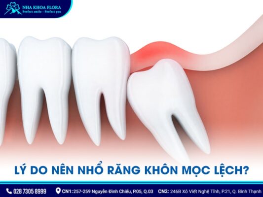 nhổ răng khôn mọc lệch - ảnh 1 nhổ răng khôn mọc lệch - ảnh 1
