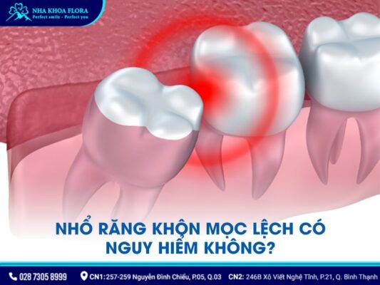 nhổ răng khôn mọc lệch - ảnh 2 nhổ răng khôn mọc lệch - ảnh 2