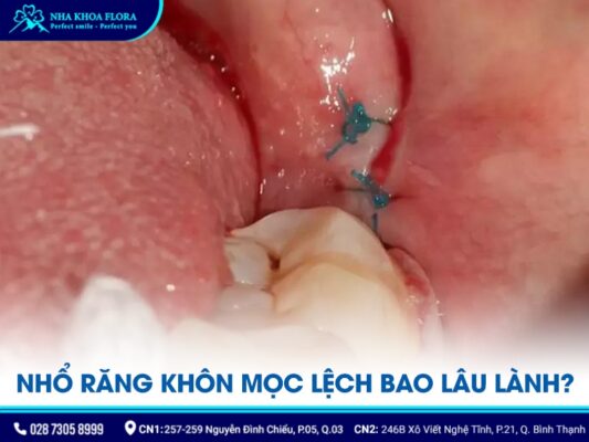 nhổ răng khôn mọc lệch - ảnh 3 nhổ răng khôn mọc lệch - ảnh 3