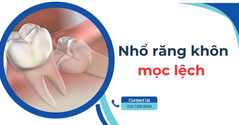 nhổ răng khôn mọc lệch