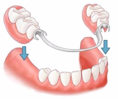 rang-sau-vao-tuy răng sâu vào tủy