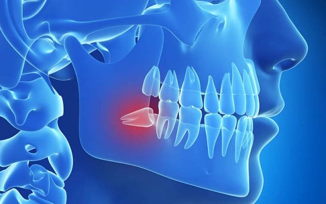 Răng khôn mọc lệch nên nhổ sớm để tránh những ảnh hưởng xấu Răng khôn mọc lệch nên nhổ sớm để tránh những ảnh hưởng xấu