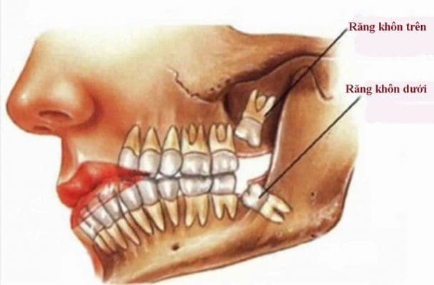 Răng khôn hàm trên và răng khôn hàm dưới