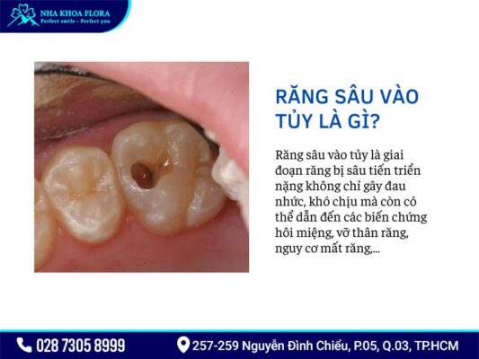 răng sâu vào tủy - ảnh 1