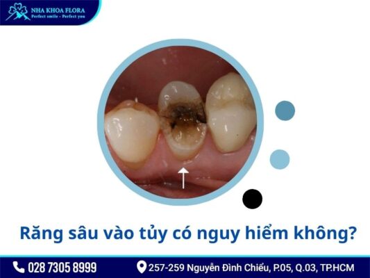răng sâu vào tủy - ảnh 2