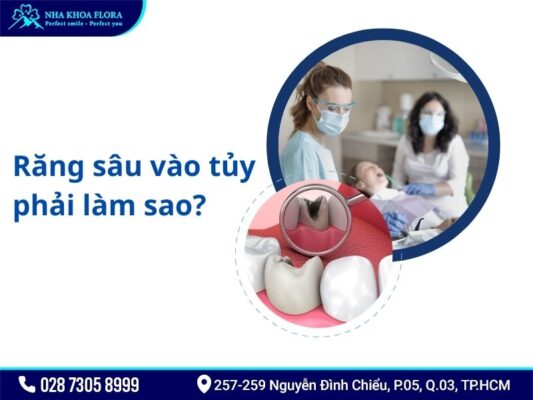 răng sâu vào tủy - ảnh 3