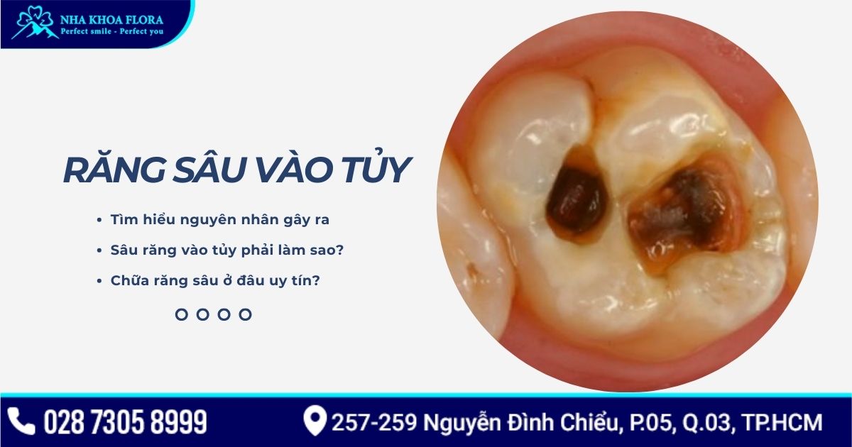 Răng sâu vào tủy phải làm sao? Điều trị bao nhiêu tiền?