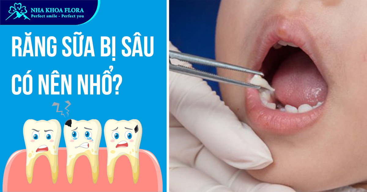 Răng sữa bị sâu có nên nhổ? Hay trám tốt hơn?