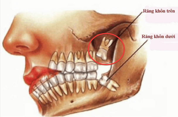 răng sâu số 8 hàm trên