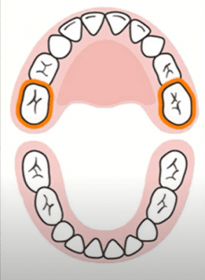 rang-sua-bi-sau răng sữa bị sâu