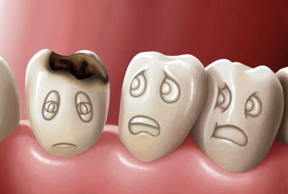 Sâu răng gây mùi hôi ở miệng Sâu răng gây mùi hôi ở miệng