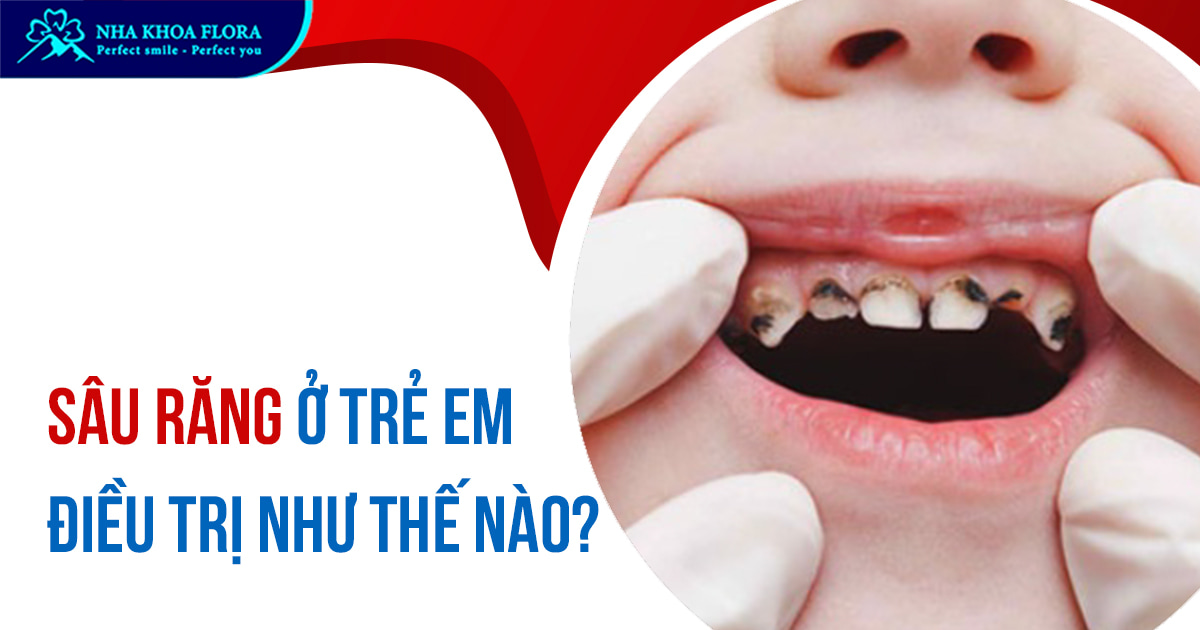 Sâu răng ở trẻ em: Nguyên nhân, Tác hại & Cách điều trị