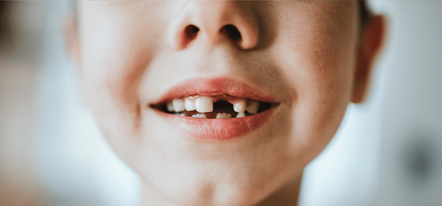 chữa sâu răng cho trẻ 2 tuổi
