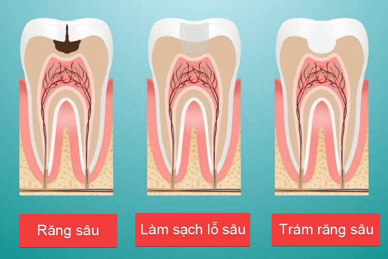 nhổ răng sâu hàm dưới