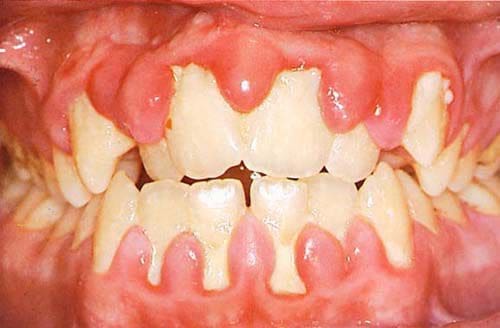dieu-tri-viem-nha-chu điều trị viêm nha chu
