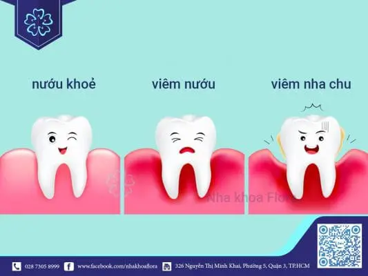 Viêm nha chu là gì? Có phải bệnh nguy hiểm không? 4