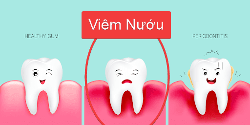 VIÊM NƯỚU VÀ VIÊM NHA CHU GIỐNG VÀ KHÁC NHAU RA SAO? 1