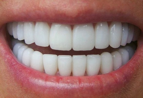 Bọc lại răng sứ mới (ảnh minh họa) Bọc lại răng sứ mới (ảnh minh họa)