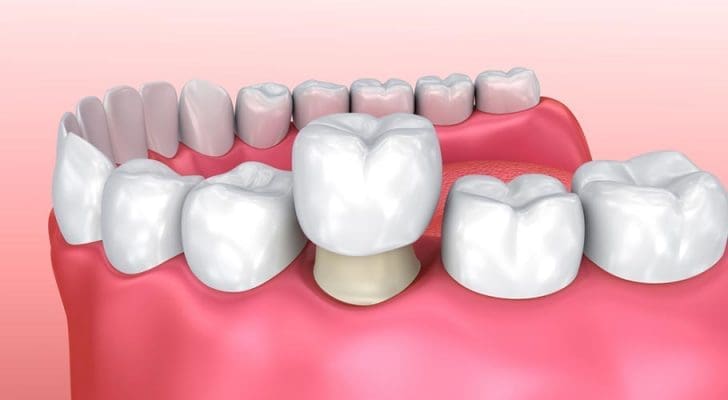 Bọc răng sứ (ảnh minh họa) Bọc răng sứ (ảnh minh họa)
