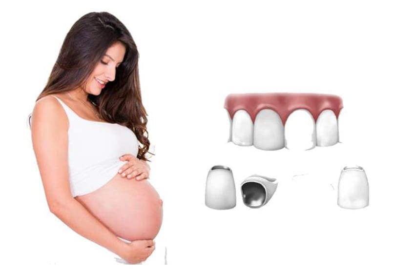 Bọc răng sứ khi mang thai (ảnh minh họa)