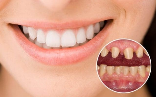 Bọc răng sứ thẩm mỹ mất thời gian bao lâu? (ảnh minh họa) Bọc răng sứ thẩm mỹ mất thời gian bao lâu? (ảnh minh họa)