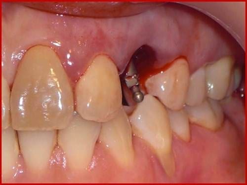 tác hại của thuốc lá với trồng răng Implant