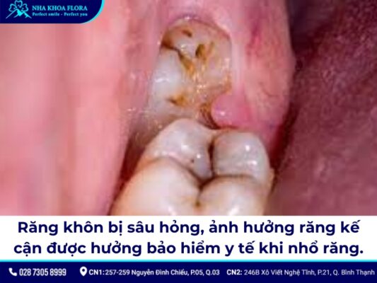 chi phí nhổ răng khôn có bảo hiểm y tế - ảnh 1 chi phí nhổ răng khôn có bảo hiểm y tế - ảnh 1