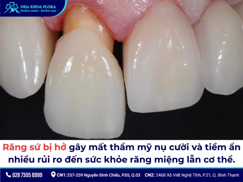 dấu hiệu răng sứ bị hở