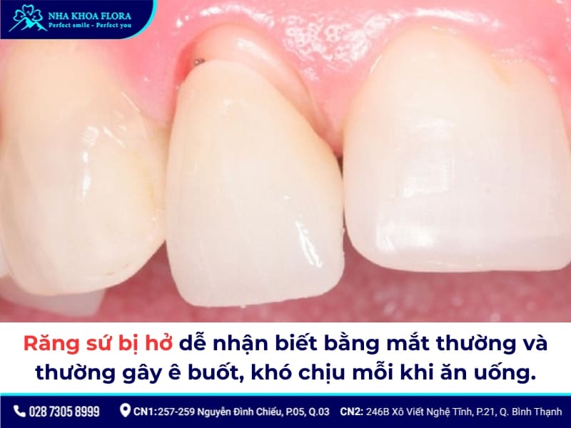 dấu hiệu răng sứ bị hở