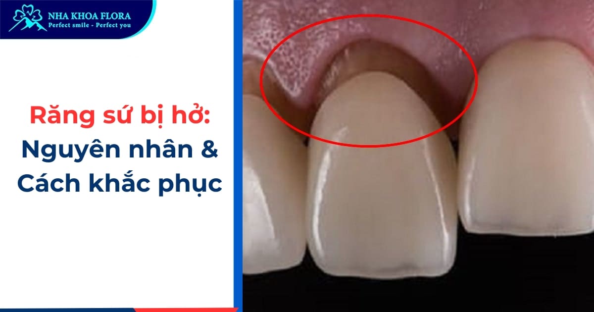 Dấu hiệu răng sứ bị hở là gì? Nguyên nhân và cách khắc phục
