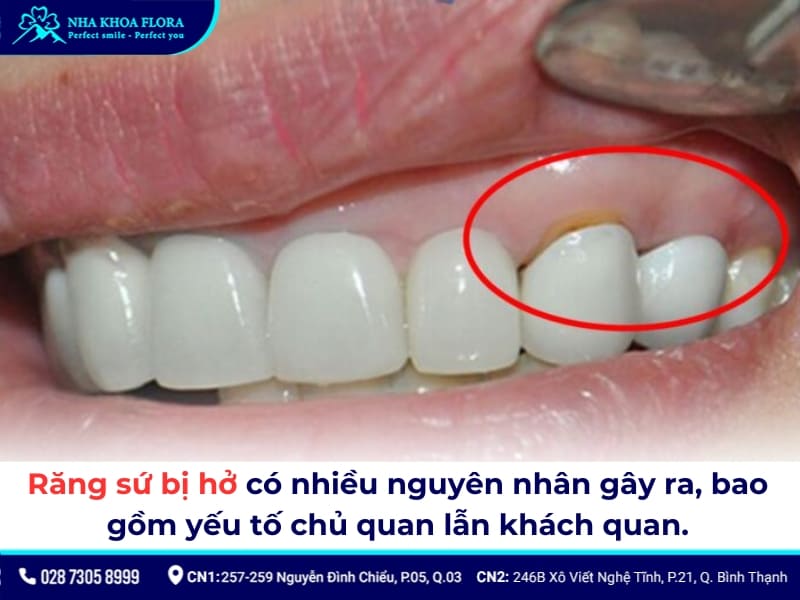 dấu hiệu răng sứ bị hở