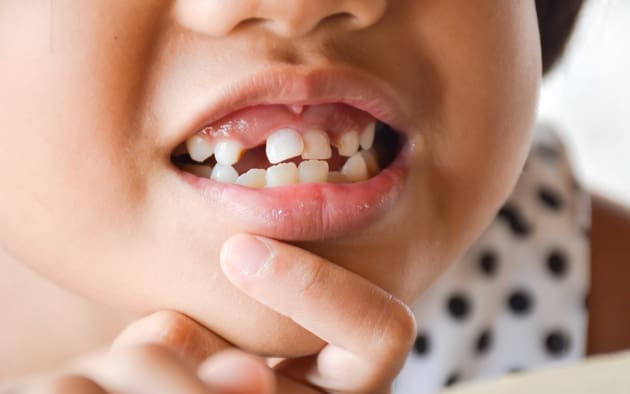 Độ tuổi nào phù hợp để bọc răng sứ (ảnh minh họa) Độ tuổi nào phù hợp để bọc răng sứ (ảnh minh họa)