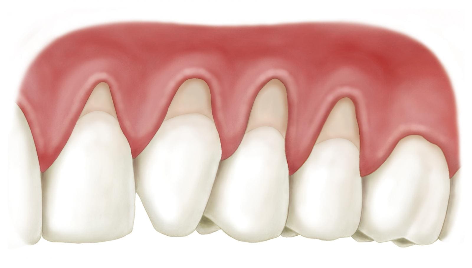 Hở cổ chân răng bọc sứ là một biến chứng nghiêm trọng, nó có thể xảy ra tại sao?
