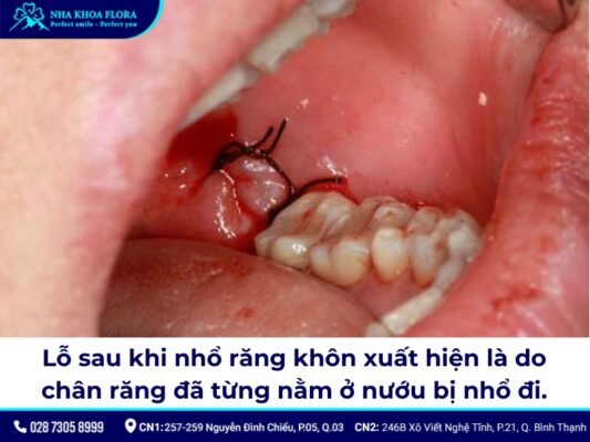 lỗ sau khi nhổ răng khôn - ảnh 1 lỗ sau khi nhổ răng khôn - ảnh 1