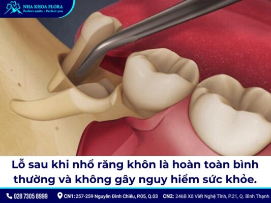lỗ sau khi nhổ răng khôn - ảnh 2 lỗ sau khi nhổ răng khôn - ảnh 2
